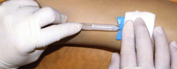 Nipro SafeTouch Tulip Safety Fistula Needle Withdrawl