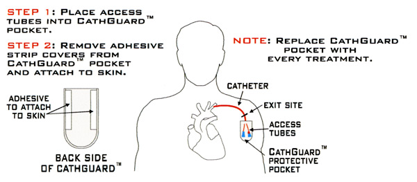 CathGuard Instructions